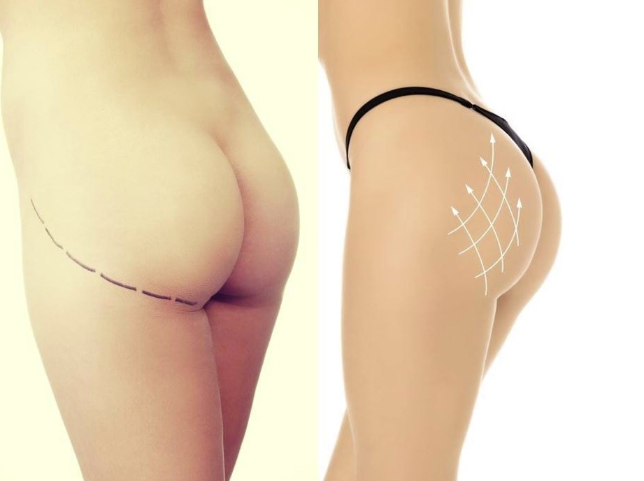 Bil fillers Bil fillers